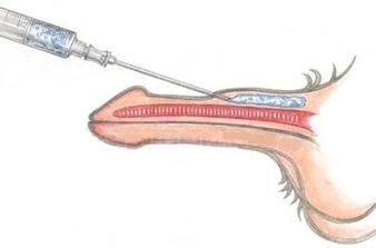 Vazelin enjeksiyonu kullanarak tehlikeli bir penis büyütme yöntemi